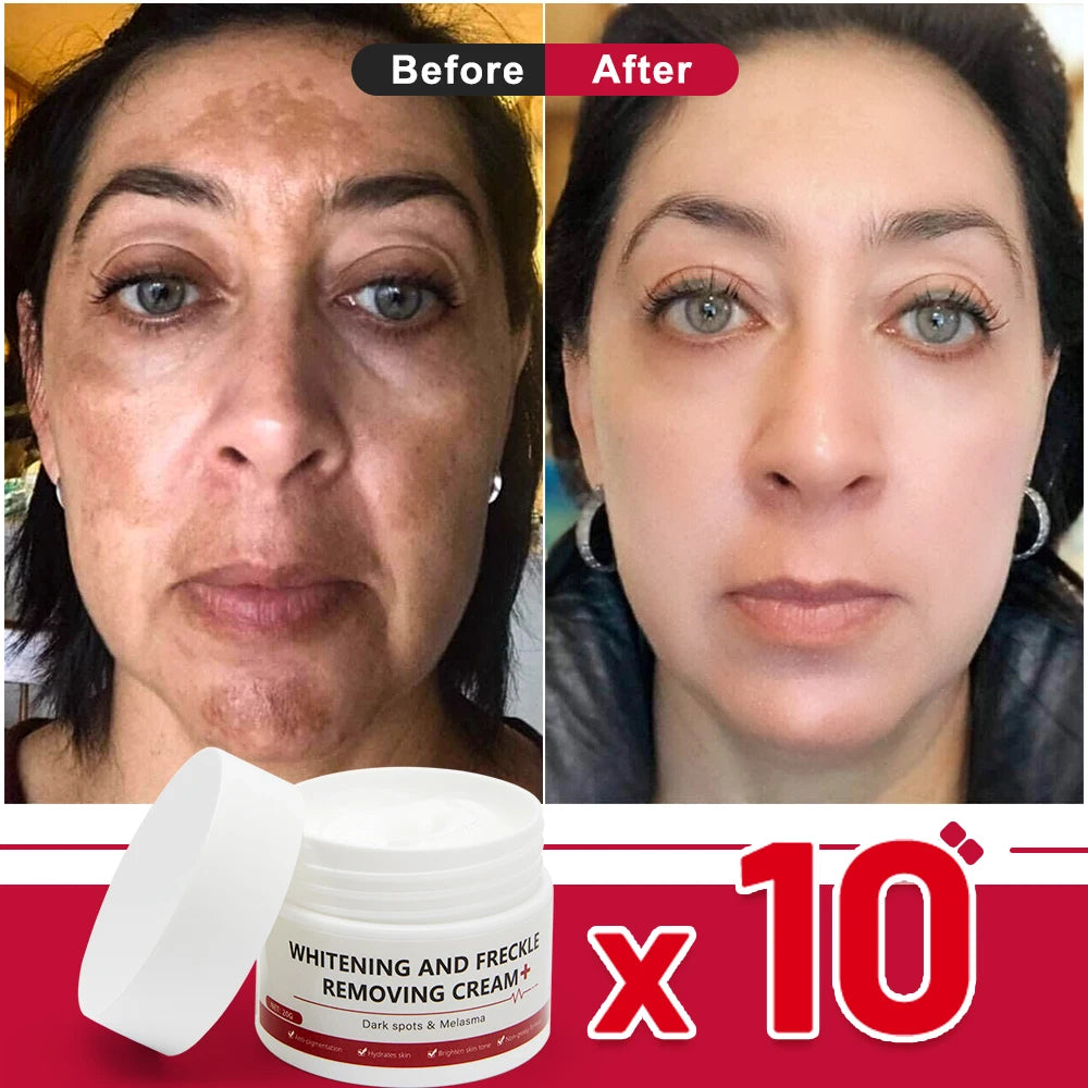 Whitening and anti-freckle cream removes dark spots, chloasma, freckles, age spots, lightens pigmentation, removes facial spots