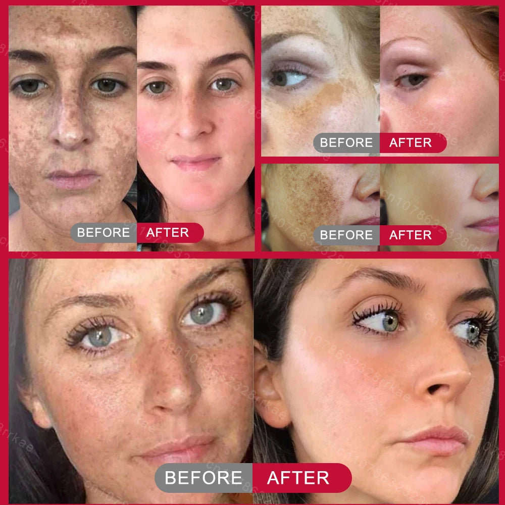 Whitening and anti-freckle cream removes dark spots, chloasma, freckles, age spots, lightens pigmentation, removes facial spots