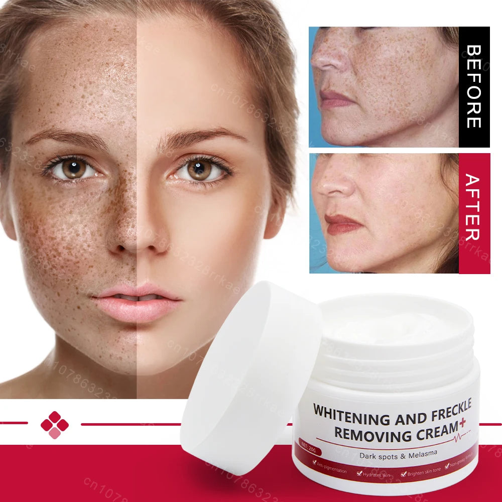 Whitening and anti-freckle cream removes dark spots, chloasma, freckles, age spots, lightens pigmentation, removes facial spots